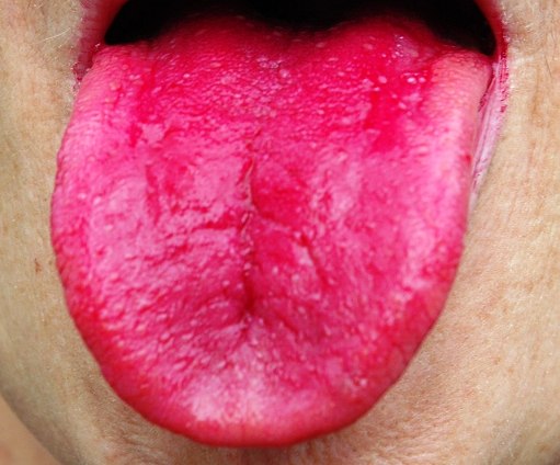 Rote Zunge